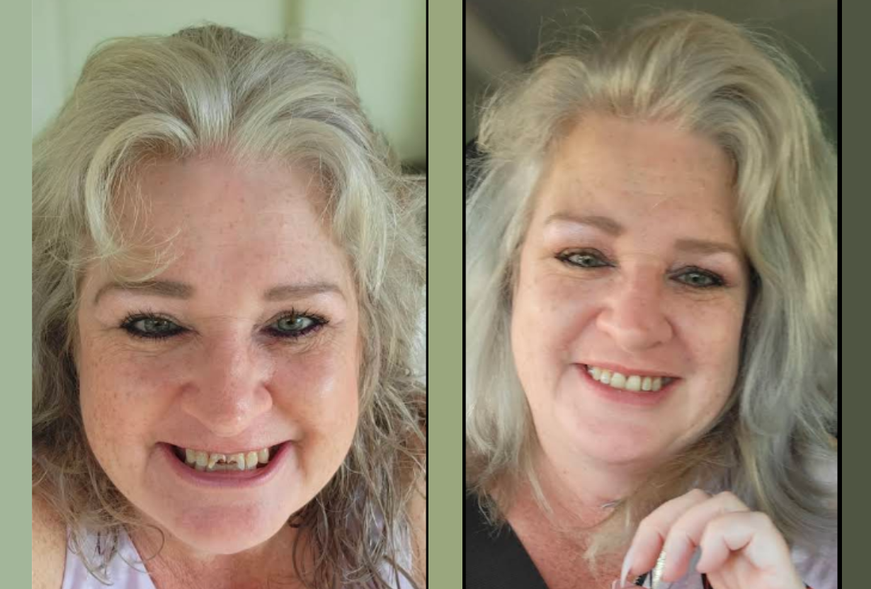 Before and after patient smile Winchester VA