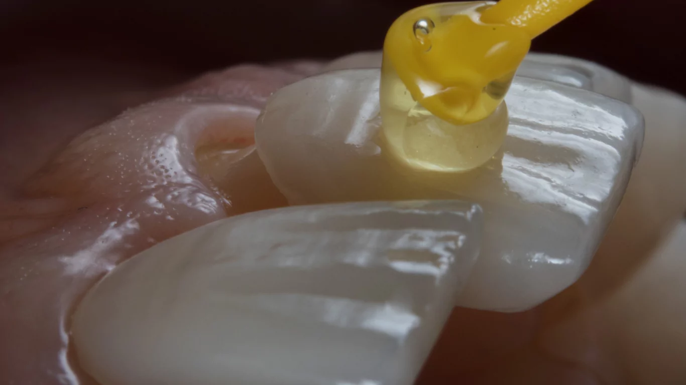 Close-up view of porcelain veneer application on a tooth with dental adhesive, showing precision placement during cosmetic dental procedure.