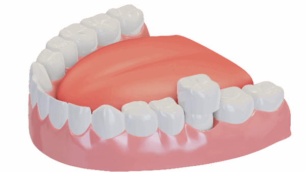 Image showing same-day dental crowns procedure in Winchester, VA, offering a quick and convenient solution for restoring your smile.