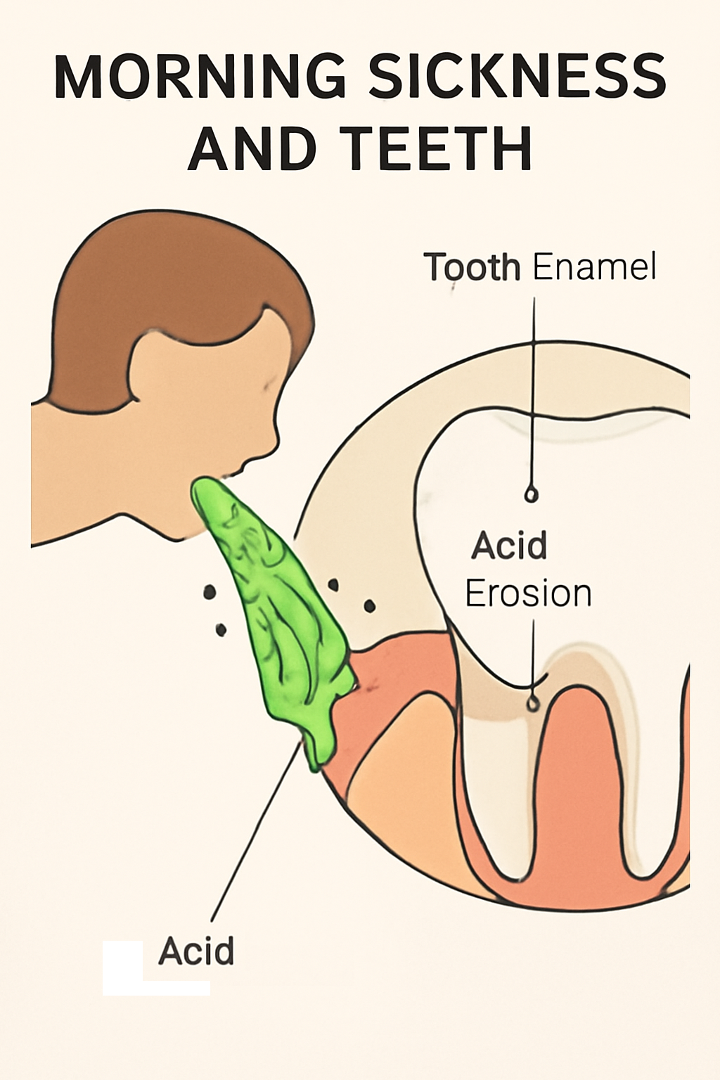 2D educational illustration titled 'Morning Sickness and Teeth,' showing a person vomiting and the resulting acid erosion on tooth enamel, highlighting the effects of stomach acids on teeth during vomiting