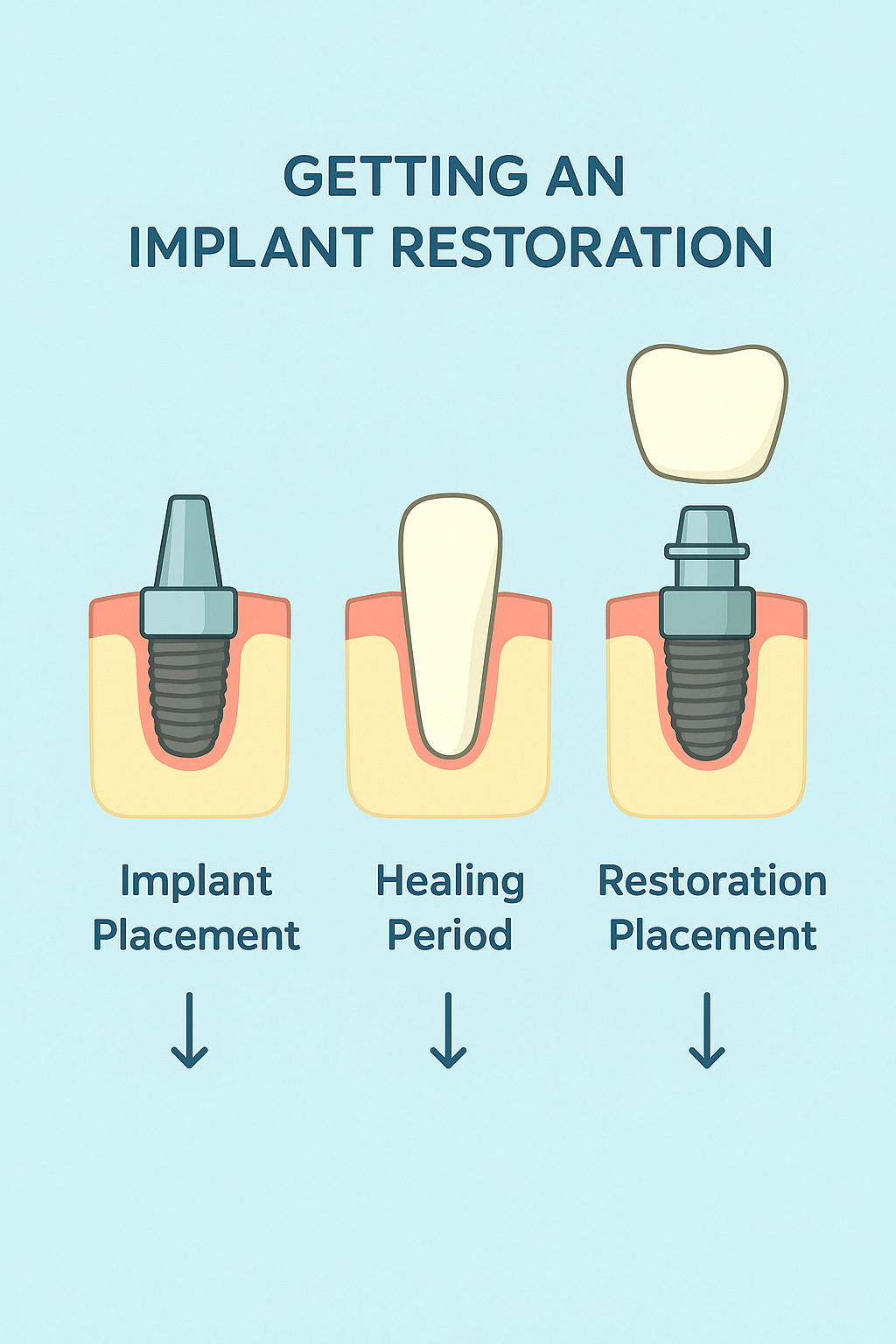 Infographic showing the three stages of getting an implant restoration: implant placement, healing period, and restoration placement, with simple dental illustrations