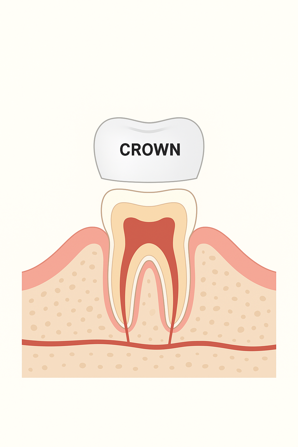 Diagram showing how a dental crown fits over a natural tooth