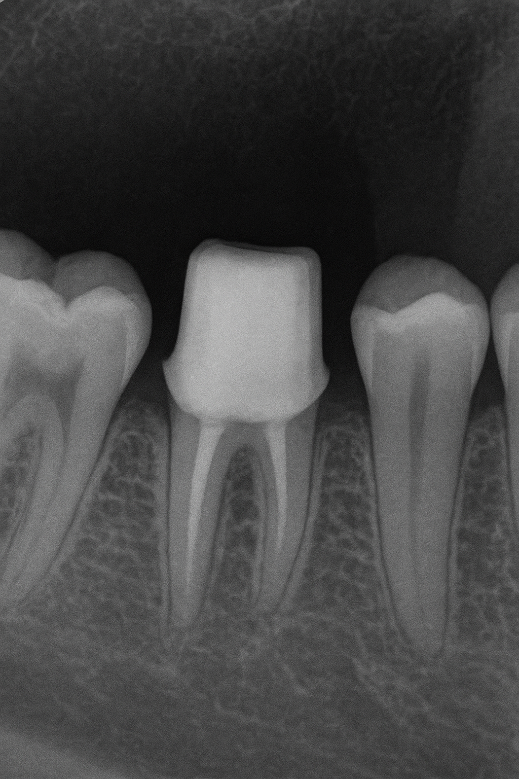 Dental X-ray of a tooth prepared for a crown in Winchester, VA.