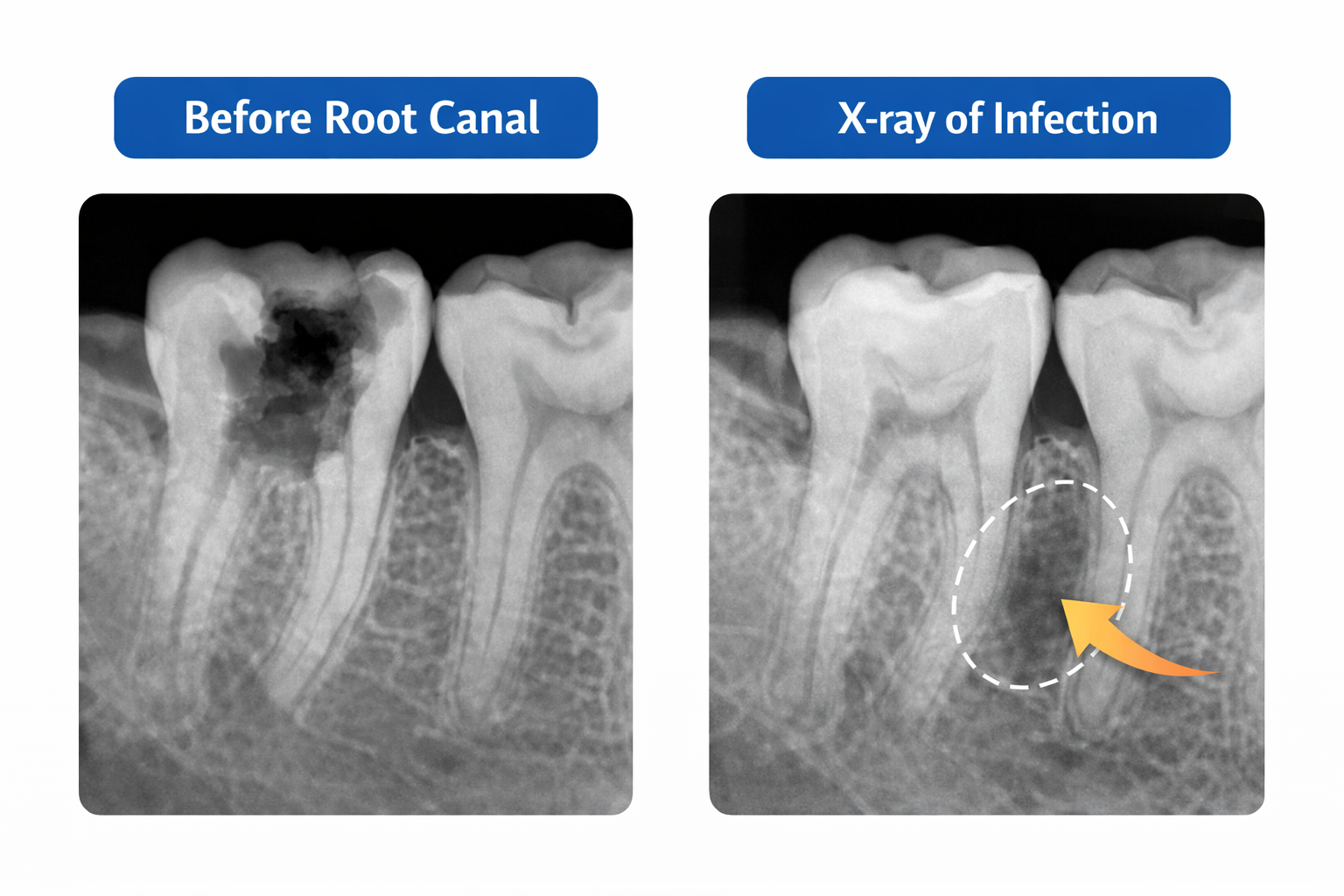 Side-by-side dental X-rays showing severe tooth decay before root canal treatment and a root infection highlighted near the tooth apex for diagnosis.